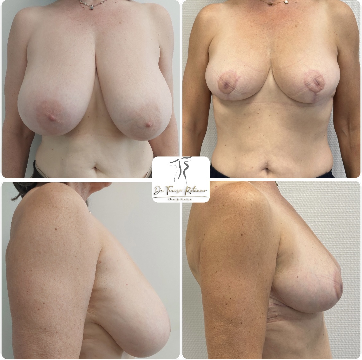 Réduction mammaire Genève Suisse